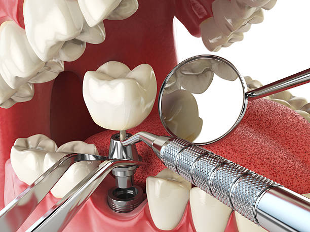 Best Knocked-Out Tooth (Avulsed Tooth) Treatment in Lexington, OK